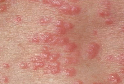 This is what Nodular Scabies can do to your skin